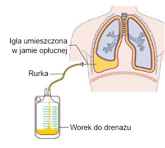Grafika przedstawiająca usuwanie płynu z jamy opłucnej w w trakcie nowotworu płuc
